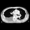 thumbnail image of Tuberculosis: chest CT with findings of mycobacterial vs fungal disease