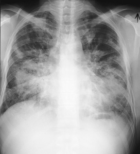 image of Kaposi sarcoma, pulmonary: chest X ray
