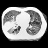 thumbnail image of  Pneumocystis jiroveci
                    (formerly
                    carinii
                    ) pneumonia
                