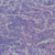 thumbnail image of Lymphocytic interstitial pneumonitis/pulmonary lymphocytic hyperplasia: lung biopsy