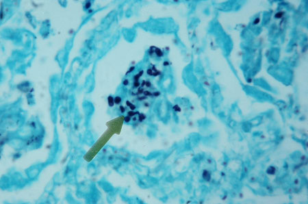 image of  Pneumocystis jiroveci
                    (formerly
                    carinii
                    ) pneumonia
                