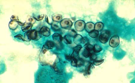 image of  Pneumocystis jiroveci
                    (formerly
                    carinii
                    ) pneumonia
                