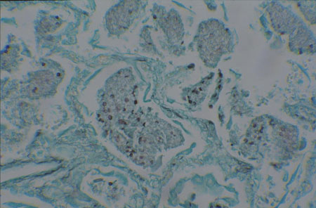 image of  Pneumocystis jiroveci
                    (formerly
                    carinii
                    ) pneumonia: lung biopsy
                