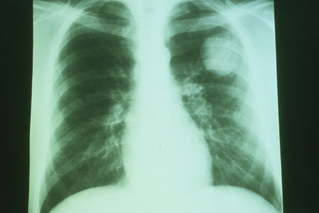 image of Non-Hodgkin lymphoma: chest X ray showing isolated pulmonary nodule in patient with AIDS