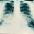 thumbnail image of Kaposi sarcoma: chest X ray showing pulmonary involvement