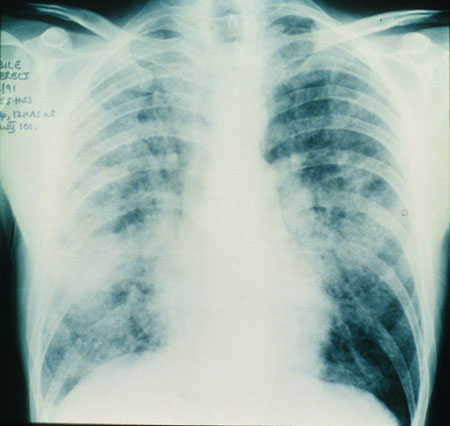 image of Kaposi sarcoma: chest X ray showing pulmonary involvement