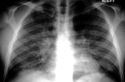 image of Tuberculosis (disseminated): chest X ray with diffuse opacities and bilateral hilar adenopathy