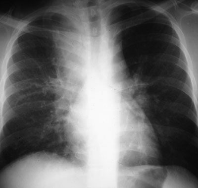 image of Tuberculosis: chest X ray with adenopathy