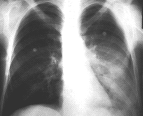 image of Pneumococcal pneumonia, bacteremic: chest X ray showing left lower lobe consolidation