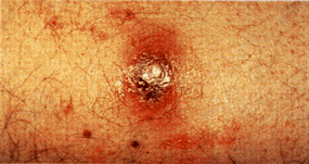 image of Bacillary angiomatosis: an unusual-appearing plaque in cutaneous disease