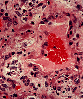 image of  Bartonella henselae
                    /Bacillary angiomatosis: cutaneous biopsy
                