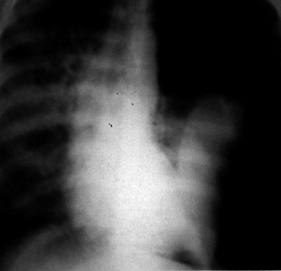 image of  Pneumocystis jiroveci
                    (formerly
                    carinii
                    ) pneumonia: chest X ray showing left tension pneumothorax
                