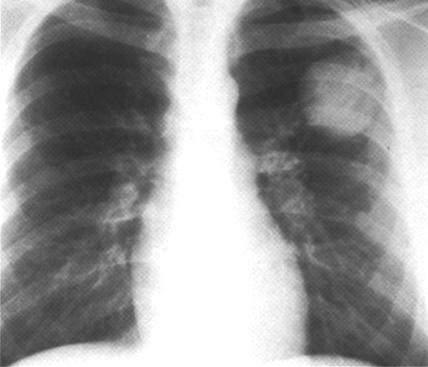 image of Non-Hodgkin lymphoma: initial chest radiograph and radiograph 6 weeks later