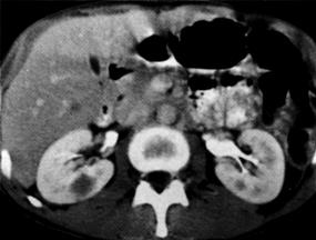 image of Non-Hodgkin lymphoma: bilateral renal masses