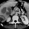 thumbnail image of Non-Hodgkin lymphoma: multiple hepatic masses