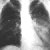 thumbnail image of Pneumococcal pneumonia, bacteremic: chest X ray showing left lower lobe consolidation