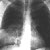 thumbnail image of Pneumococcal pneumonia: bacteremic with cavitation and a new pleural effusion