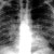 thumbnail image of Tuberculosis (disseminated): chest X ray with diffuse opacities and bilateral hilar adenopathy
