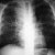 thumbnail image of Tuberculosis: chest X ray with adenopathy