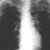 thumbnail image of  Pneumocystis jiroveci
                    (formerly
                    carinii
                    ) pneumonia: chest X ray with apical infiltrate
                