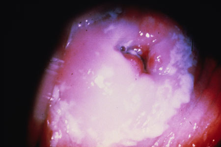 image of Candida: on cervix