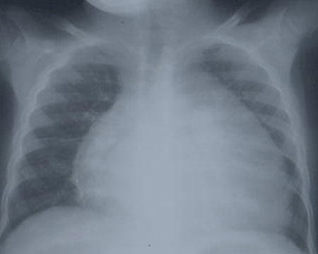 image of Cardiomegaly: chest radiograph