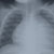 thumbnail image of Cardiomegaly: chest radiograph