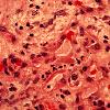 thumbnail image of Bacillary angiomatosis: biopsy slide