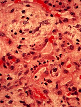 image of Bacillary angiomatosis: biopsy slide