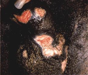 image of Herpes simplex: extensive lesions