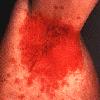 thumbnail image of Seborrheic dermatitis: axillary