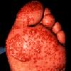 thumbnail image of Keratoderma blennorrhagicum: classic