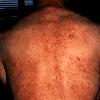 hiv lesions back