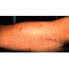 thumbnail image of Kaposi sarcoma: arm