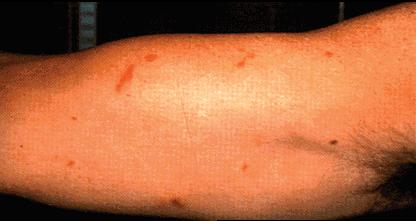 image of Kaposi sarcoma: arm