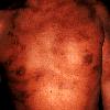 thumbnail image of Kaposi sarcoma: trunk