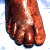 thumbnail image of Kaposi sarcoma