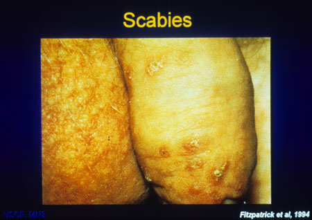 image of Scabies: on penis