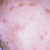thumbnail image of Eosinophilic folliculitis