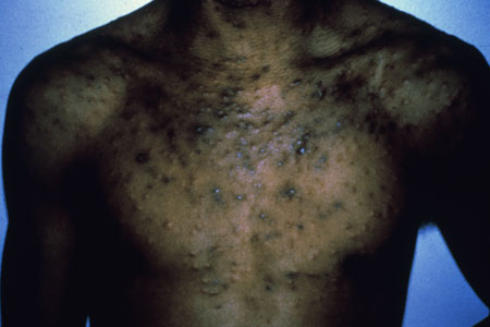 image of Eosinophilic folliculitis