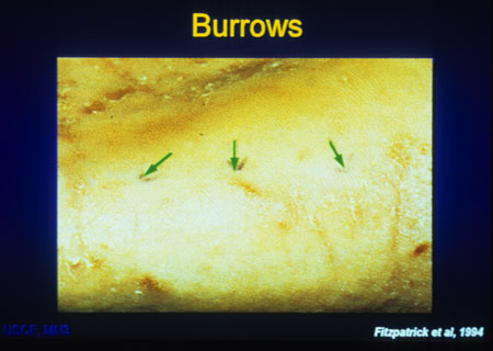 image of Scabies: showing burrows