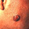 thumbnail image of Kaposi sarcoma: angiomatous nodule