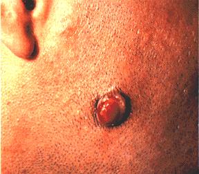 image of Kaposi sarcoma: angiomatous nodule