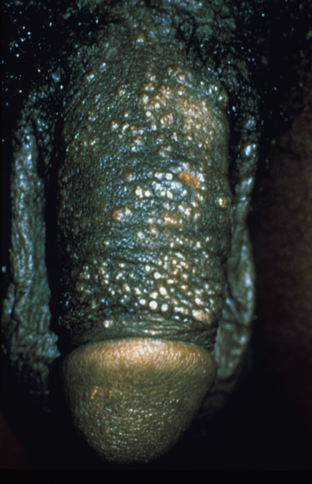 image of Molluscum contagiosum