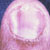 thumbnail image of Nail changes: caused by zidovudine