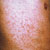 thumbnail image of Drug rash: caused by trimethroprim-sulfamethoxazole (Septra, Bactrim)