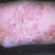 thumbnail image of Psoriasis: plaques