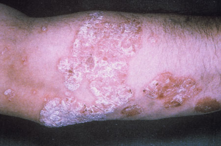 image of Psoriasis: plaques