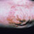 thumbnail image of Psoriasis