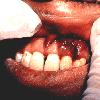 thumbnail image of Kaposi sarcoma: oral plaque
